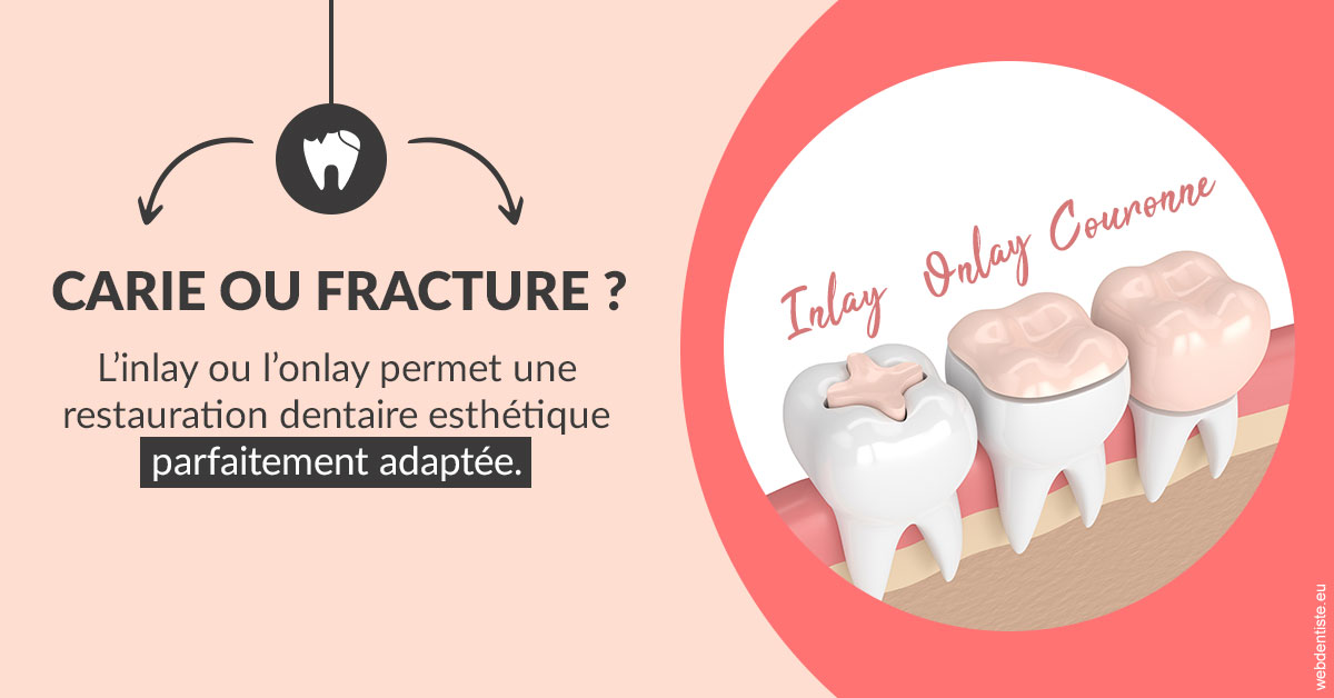 https://dr-alain-huet.chirurgiens-dentistes.fr/T2 2023 - Carie ou fracture 2