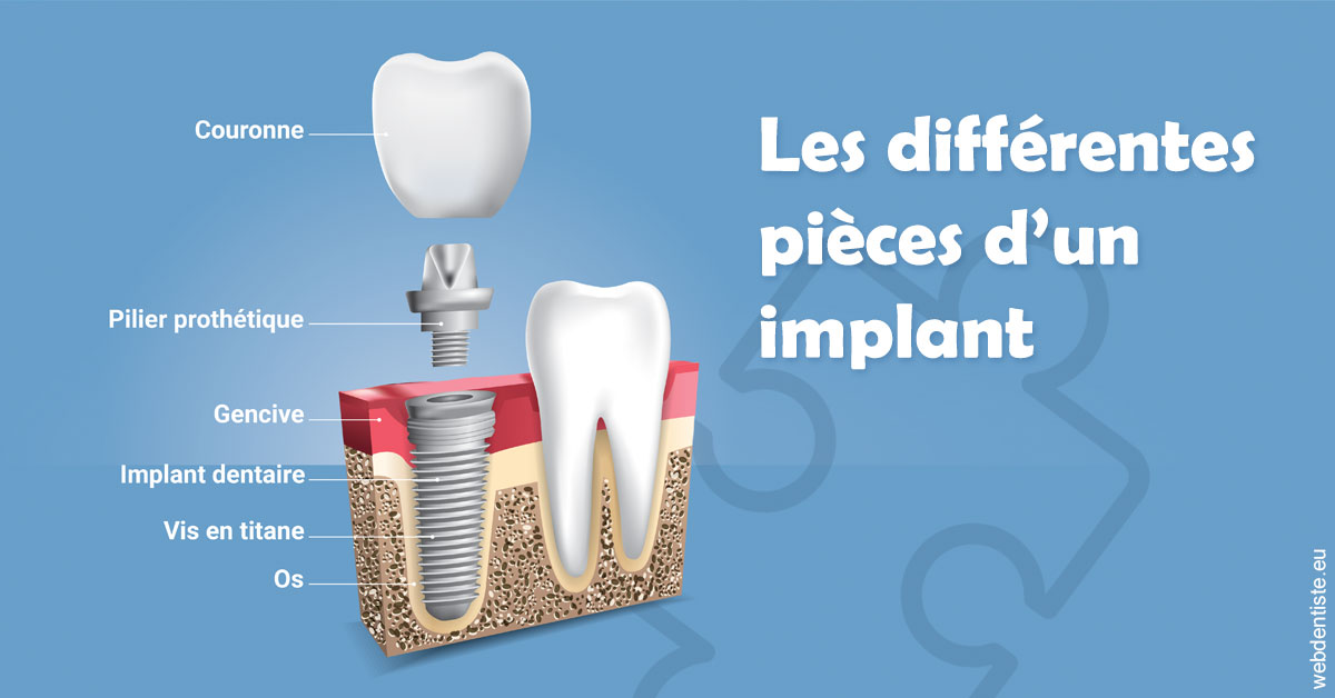 https://dr-alain-huet.chirurgiens-dentistes.fr/Les différentes pièces d’un implant 1