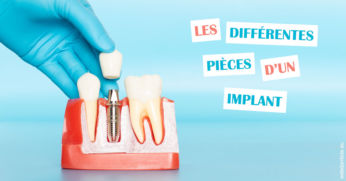 https://dr-alain-huet.chirurgiens-dentistes.fr/Les différentes pièces d’un implant 2